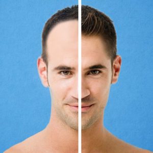 Will My Hair Require Maintenance After a Hair Transplant?